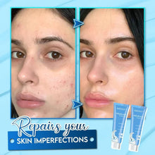 Load image into Gallery viewer, 🔥🔥Acne Removal Salicylic Acid Ice Cream Mask (Pack Of 2)🔥🔥For Both Men And Women